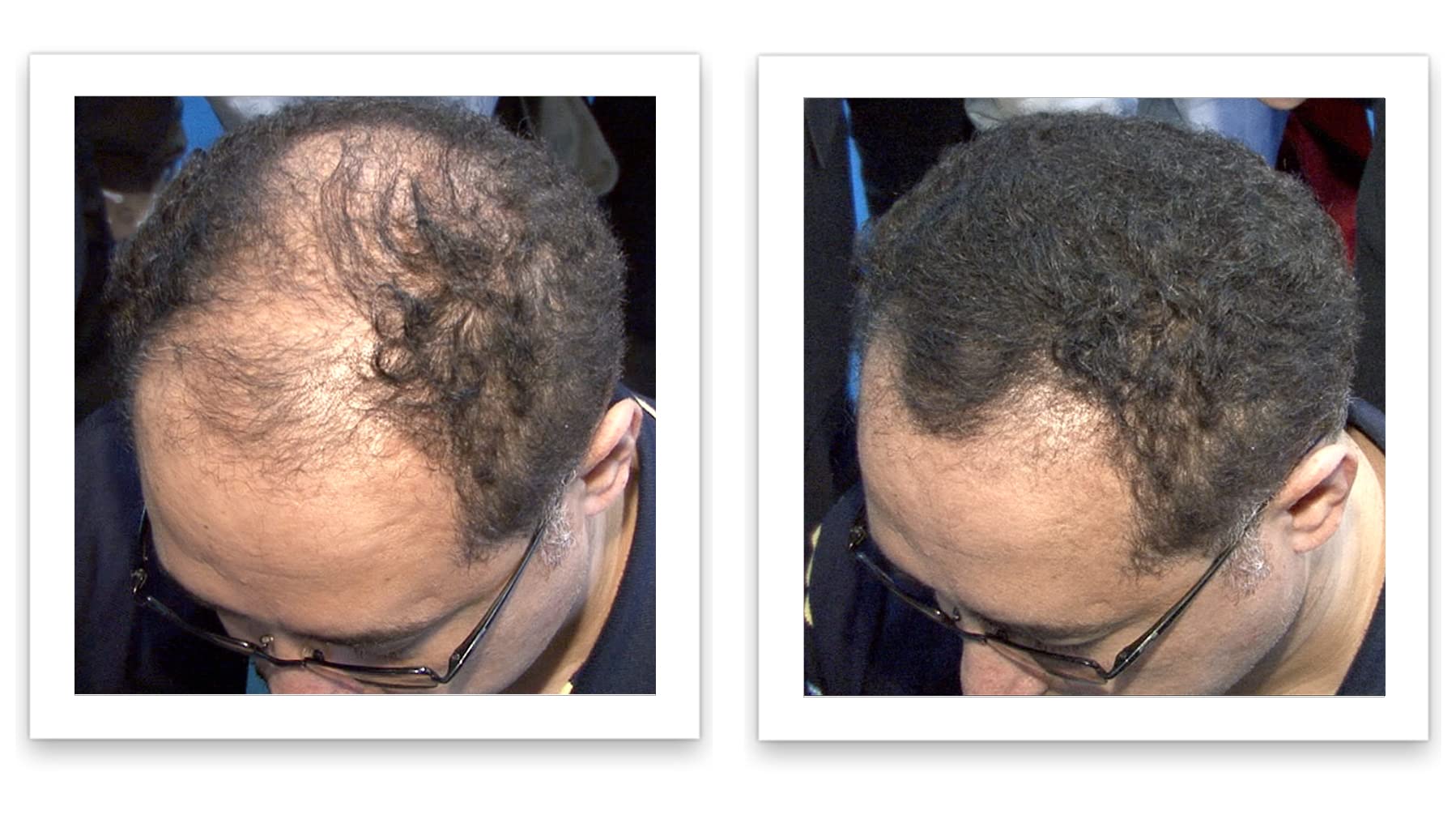 Caboki shake-and-apply fibers on thinning area for fuller appearance.
