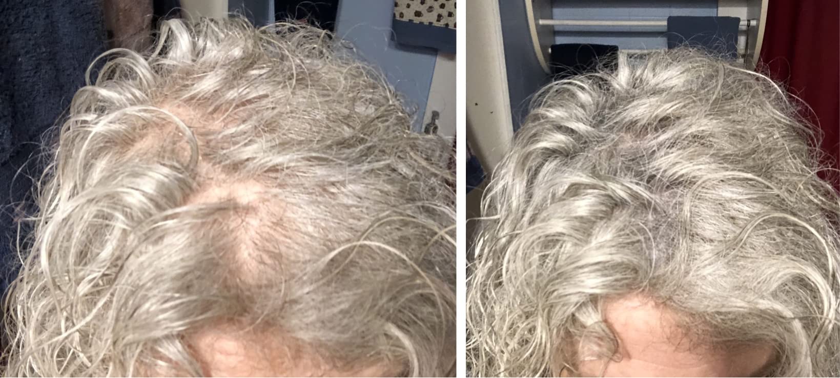 Caboki sparse hairline detail demonstrates smoother, fuller edge.