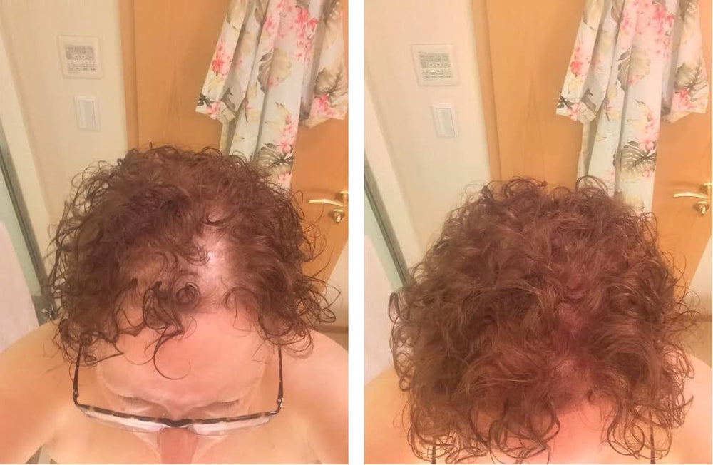 Caboki thinning hair coverage creates a visibly fuller silhouette.