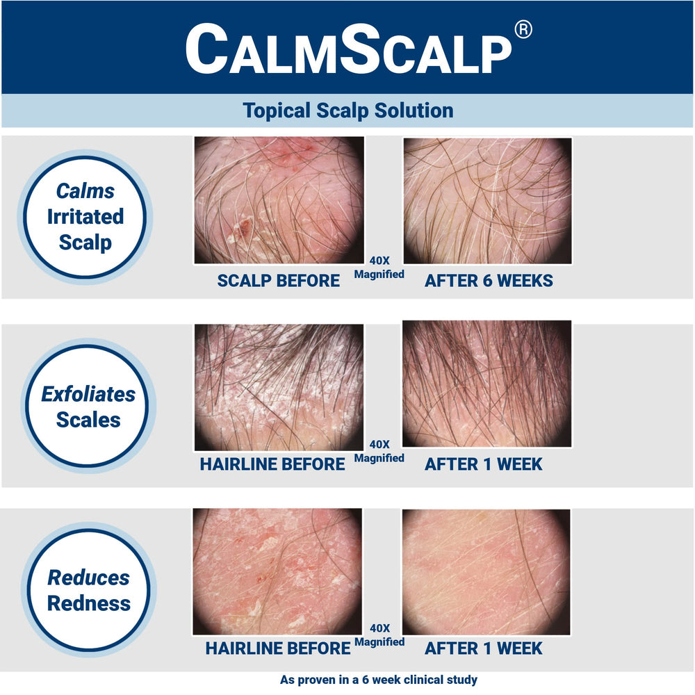 CalmScalp bottle-pour highlighting convenient, targeted scalp application