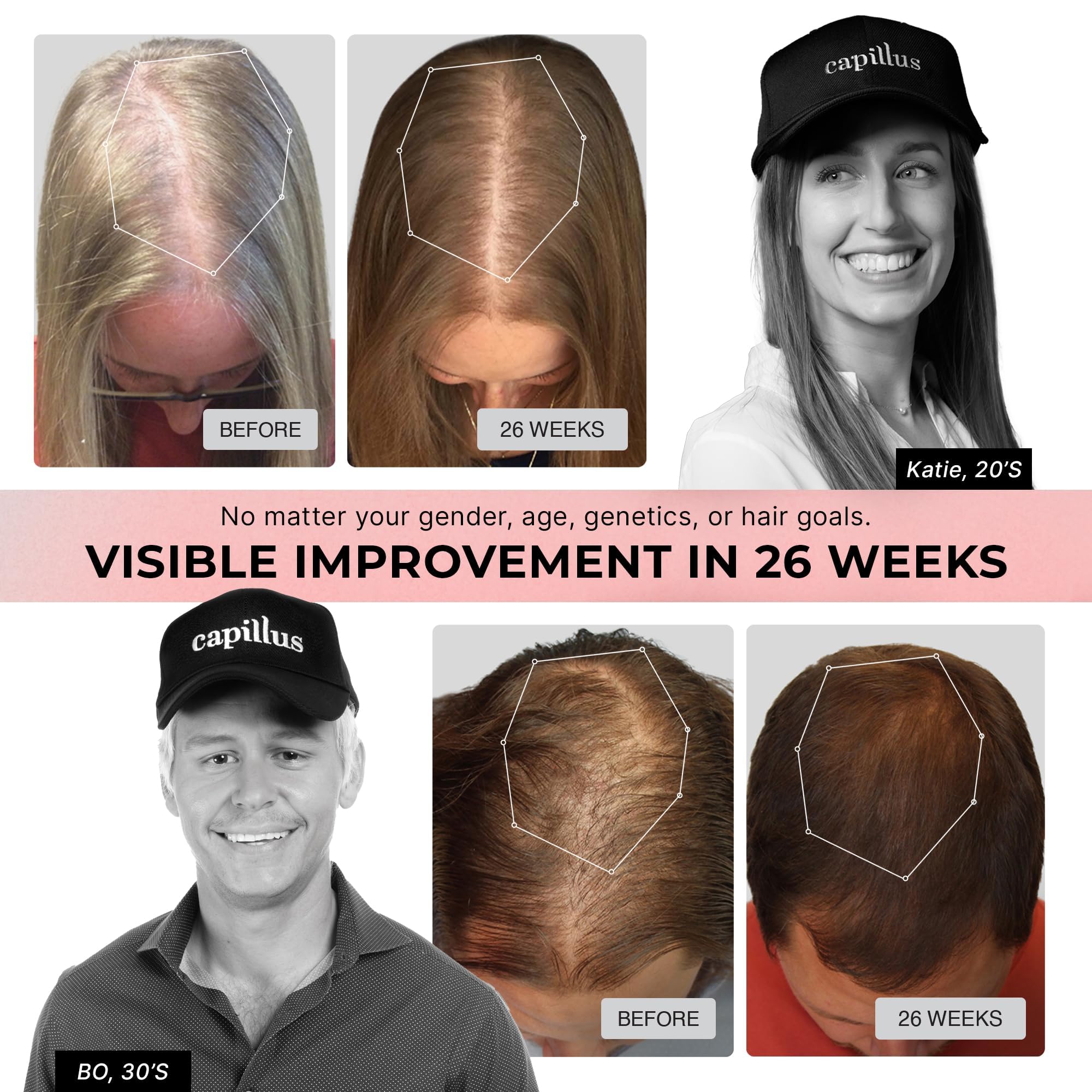 Capillus Pro S1 shows 304 laser diodes delivering even scalp exposure.