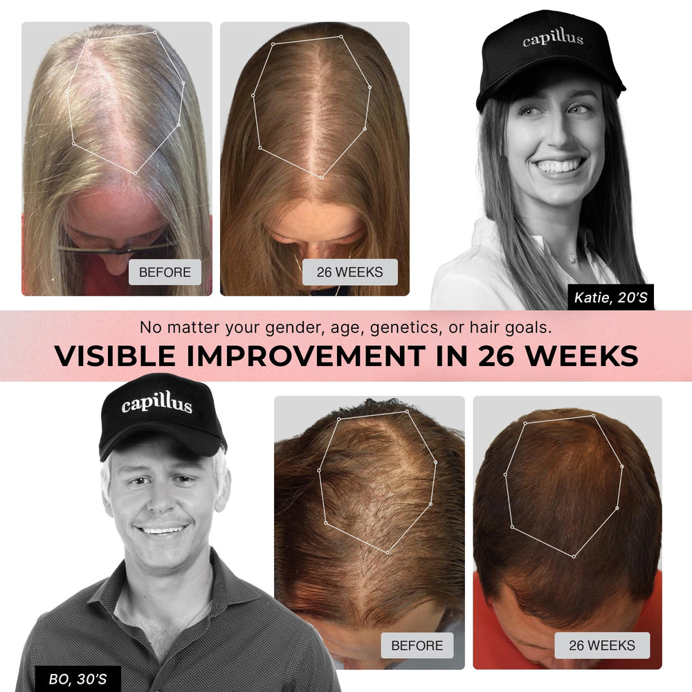 Capillus Pro S1 shows 304 laser diodes delivering even scalp exposure.