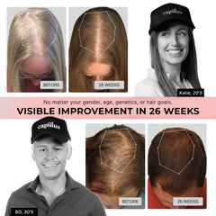 Capillus Pro S1 shows 304 laser diodes delivering even scalp exposure.