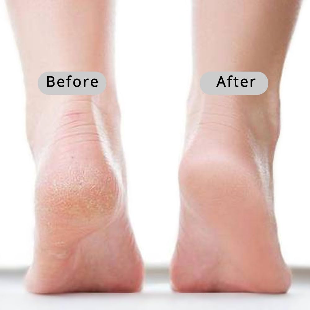 CopesFuda callus remover foot tool for safe maintenance