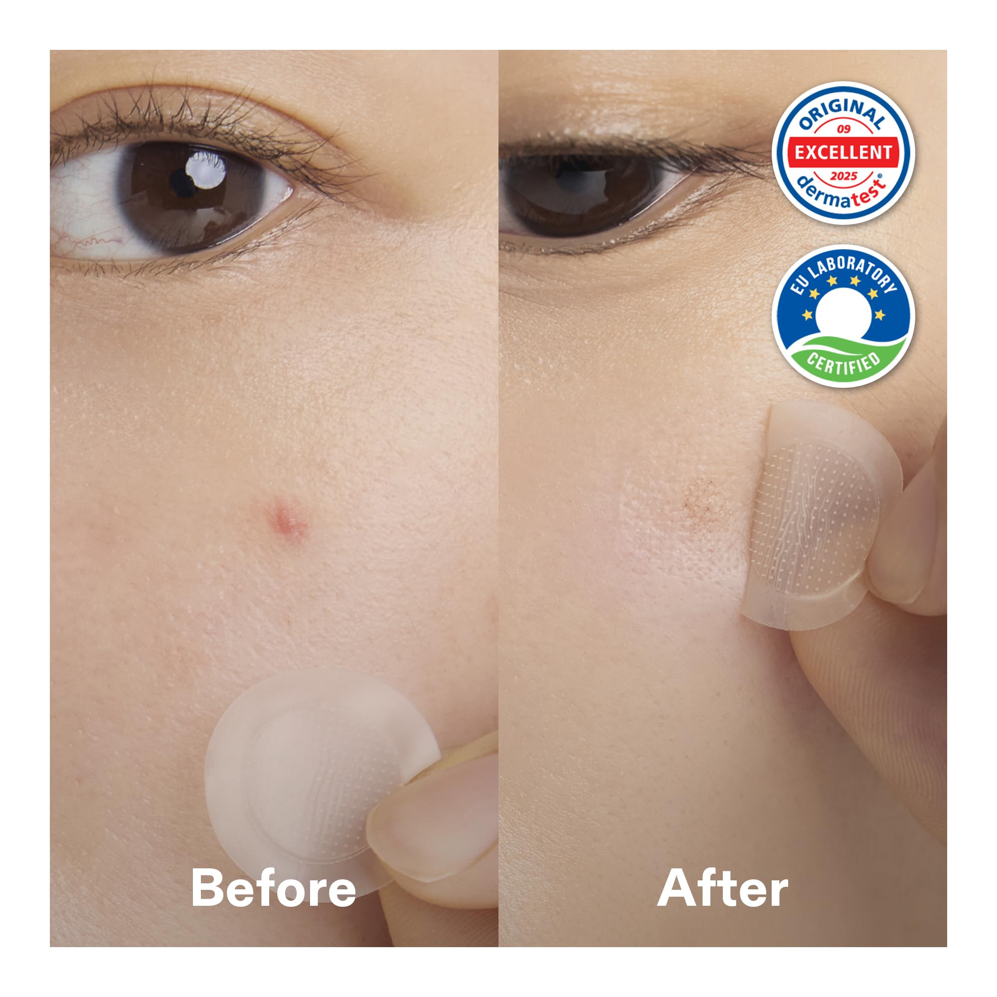 Cordiale pimple patch on skin demonstrates targeted treatment for early-stage zits.
