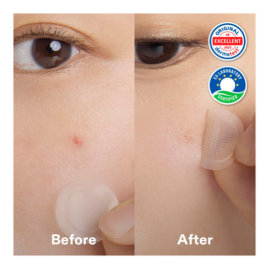 Cordiale pimple patch on skin demonstrates targeted treatment for early-stage zits.