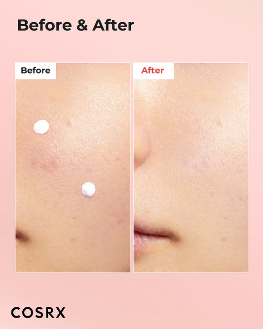 COSRX Acne Blemish Spot Drying Lotion applying dot on blemish for precise treatment