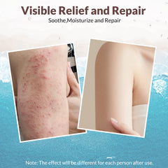 Crogooe eczema cream with aloe for hydration and cooling relief.