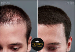 CROWN Twenty1 Hair Fibers temple-fill for balanced hairline