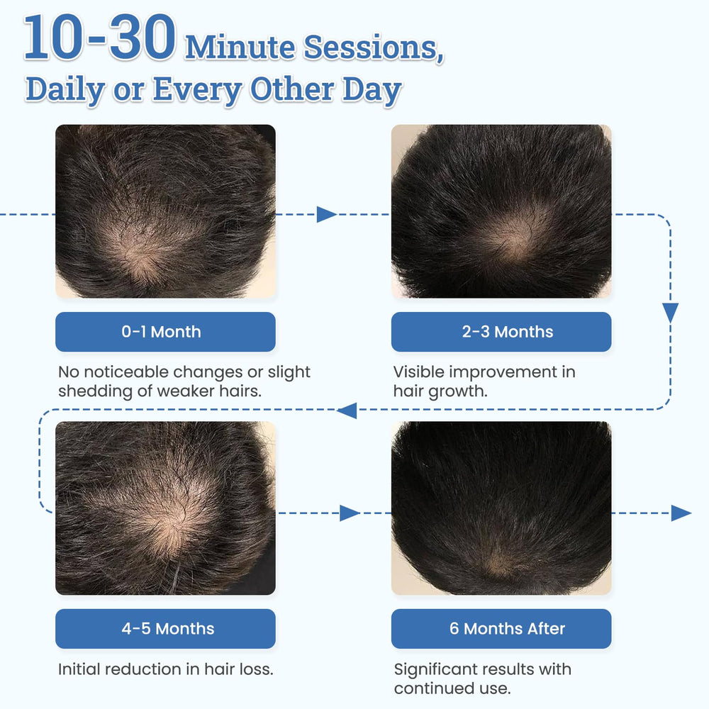 CWTUL TW316 laser diode array delivering scalp photobiostimulation