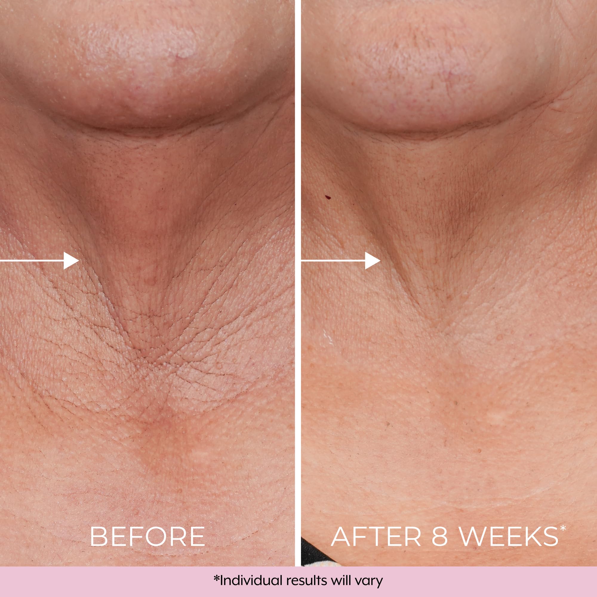 DEKLIDERM crepey neck skin close-up suggests smoothing and firming potential.