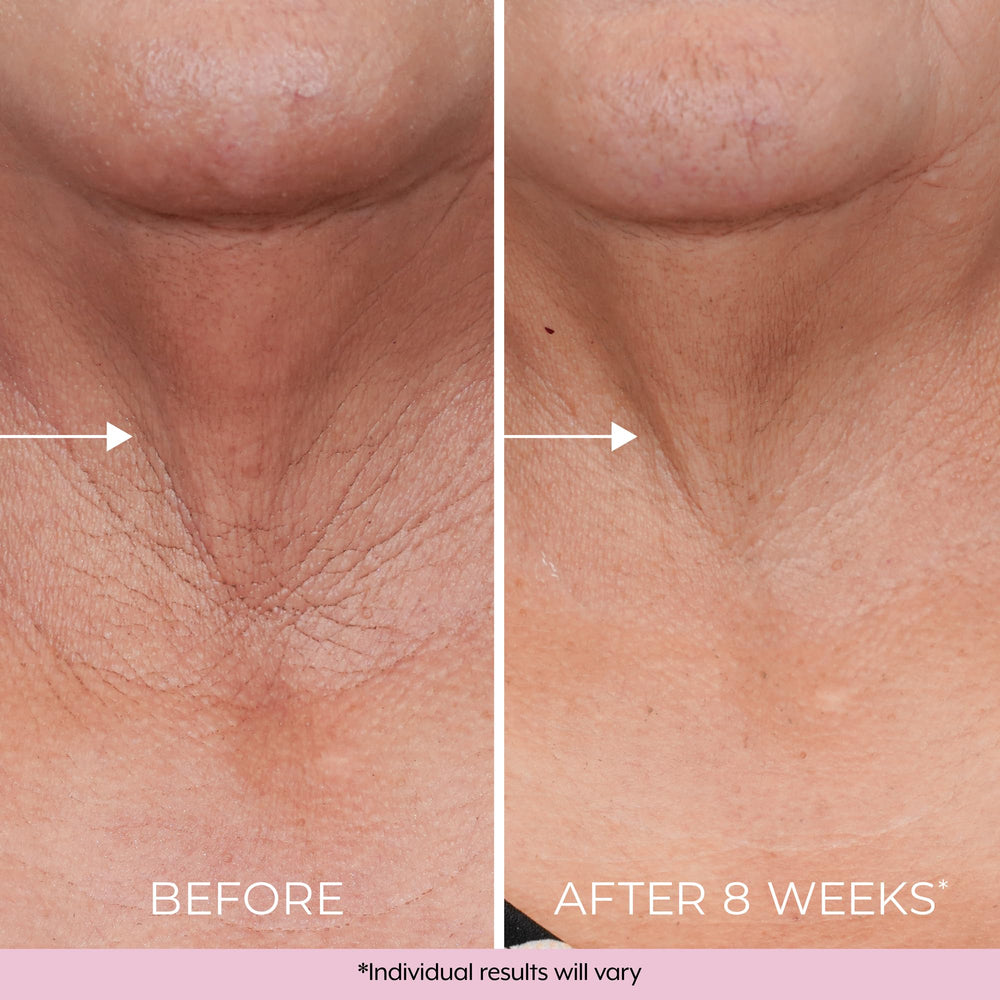 DEKLIDERM crepey neck skin close-up suggests smoothing and firming potential.