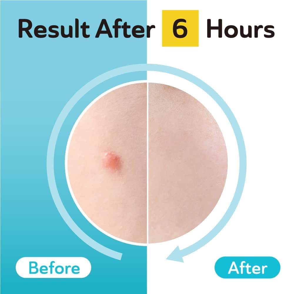 DERMA ANGEL 96-patches pack for ongoing blemish care.