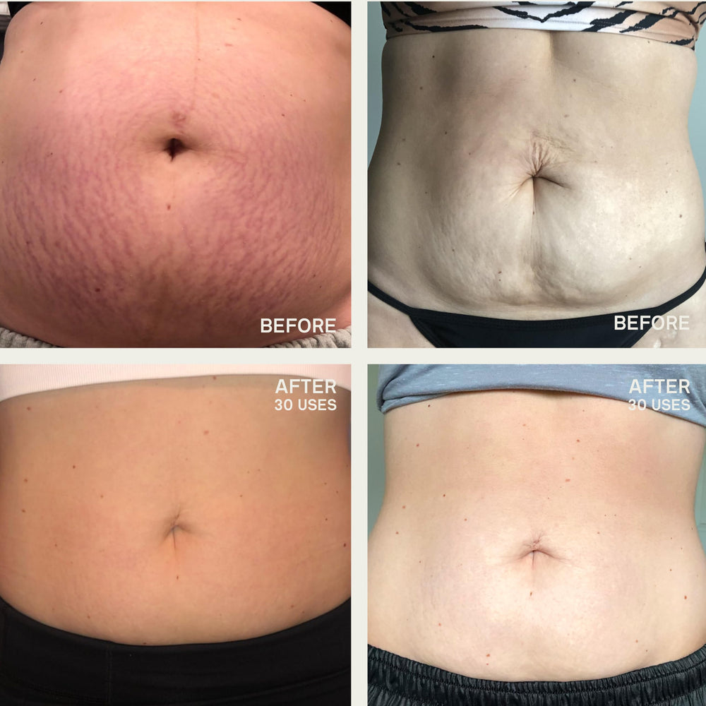 Dermaclara patch placed on stretch marks to support skin moisture