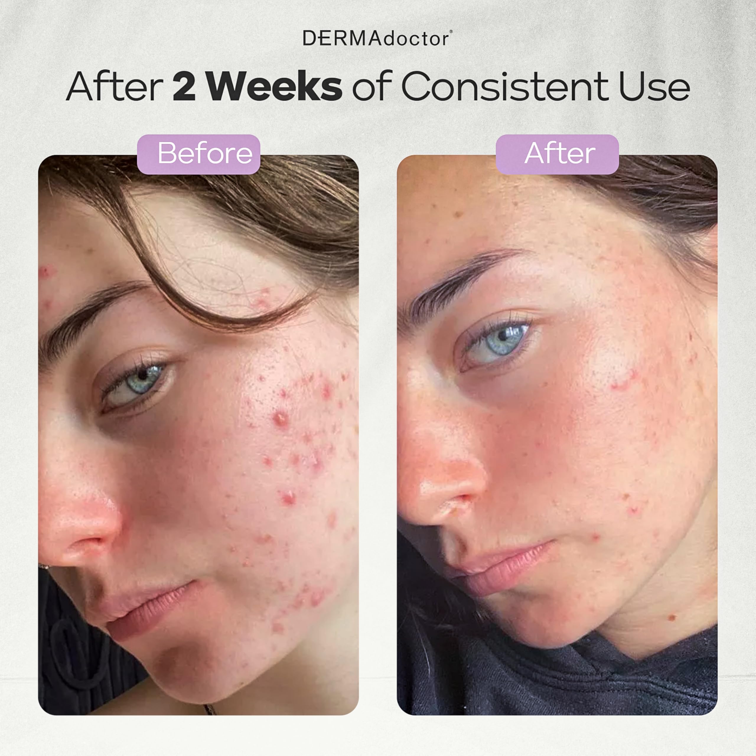 DERMAdoctor Ain't Misbehavin acne treatment helps manage oil and blackheads.