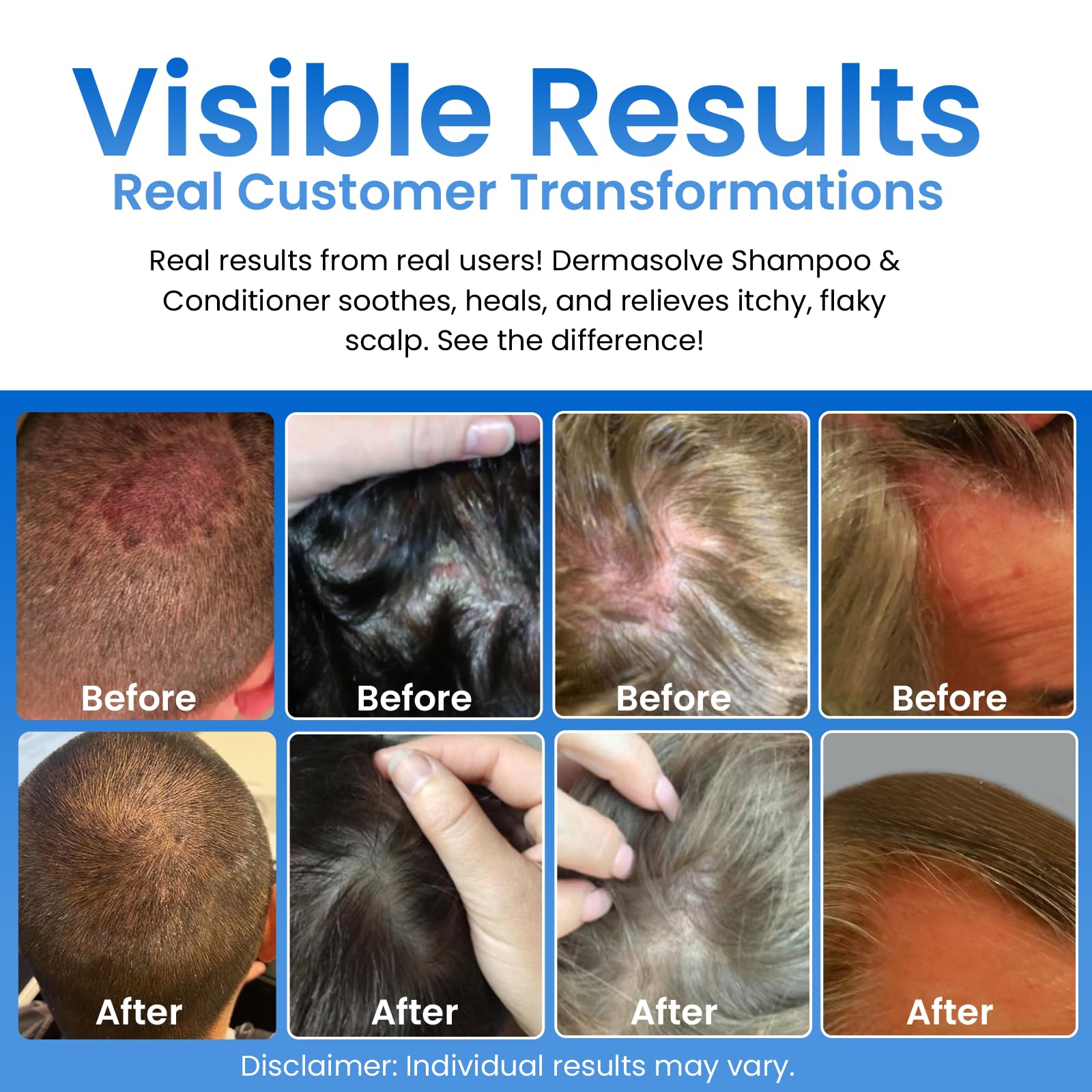 Dermasolve shampoo lather on hair for soothing cleanse