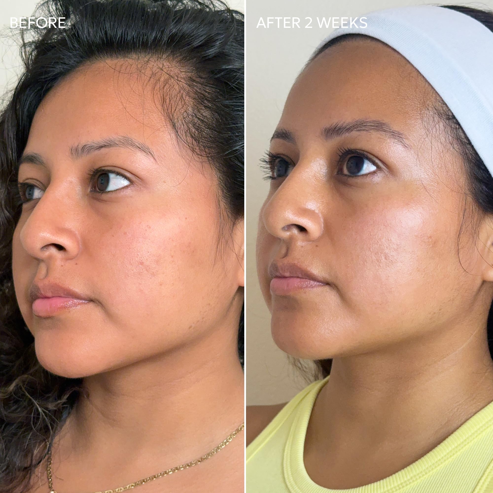 Dermisa dark spots close-up highlights areas prone to discoloration