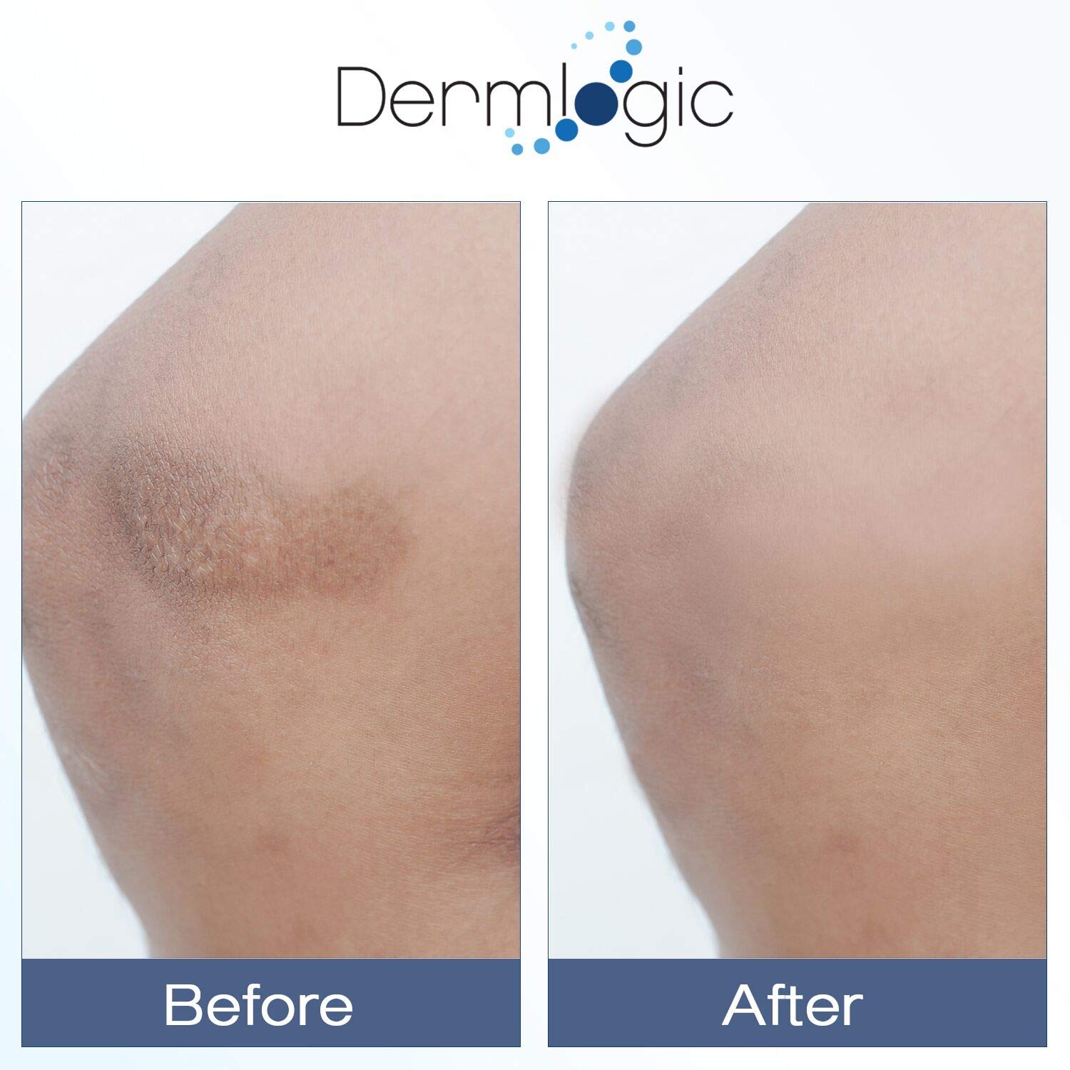 Dermlogic Vitamin K Cream under-eye application demonstrates soothing, anti-puffiness potential.