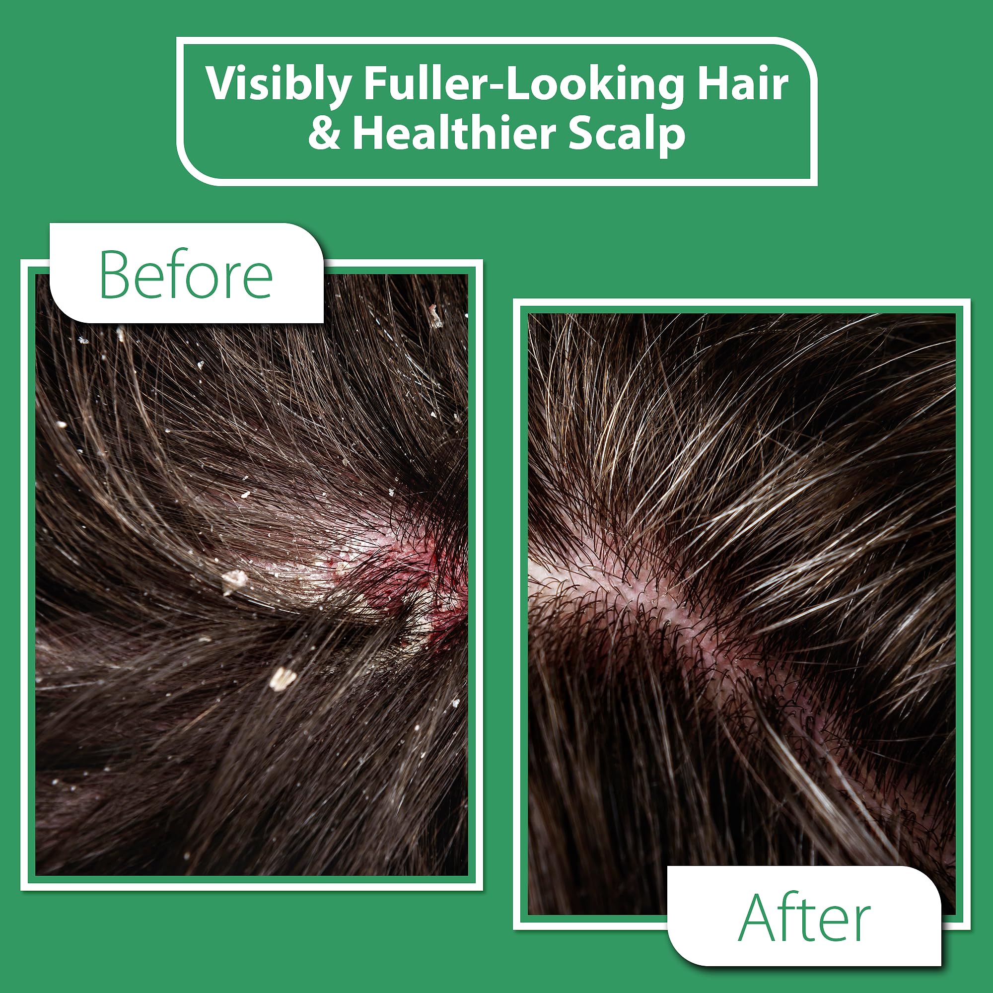 DERMOIA Tea Tree oil close up highlighting calming scalp notes