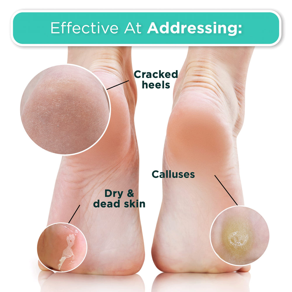 DERMORA Foot Peel Mask demonstrates heel smoothing and texture improvement.