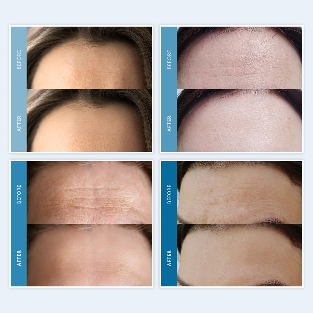 Dersie overnight-use forehead patches on skin for potential wrinkle-support while you sleep.