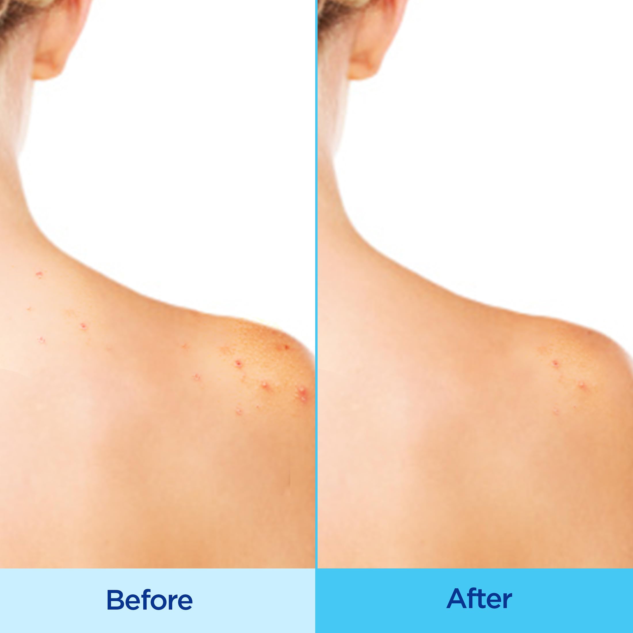 Hands applying Differin to back with even coverage