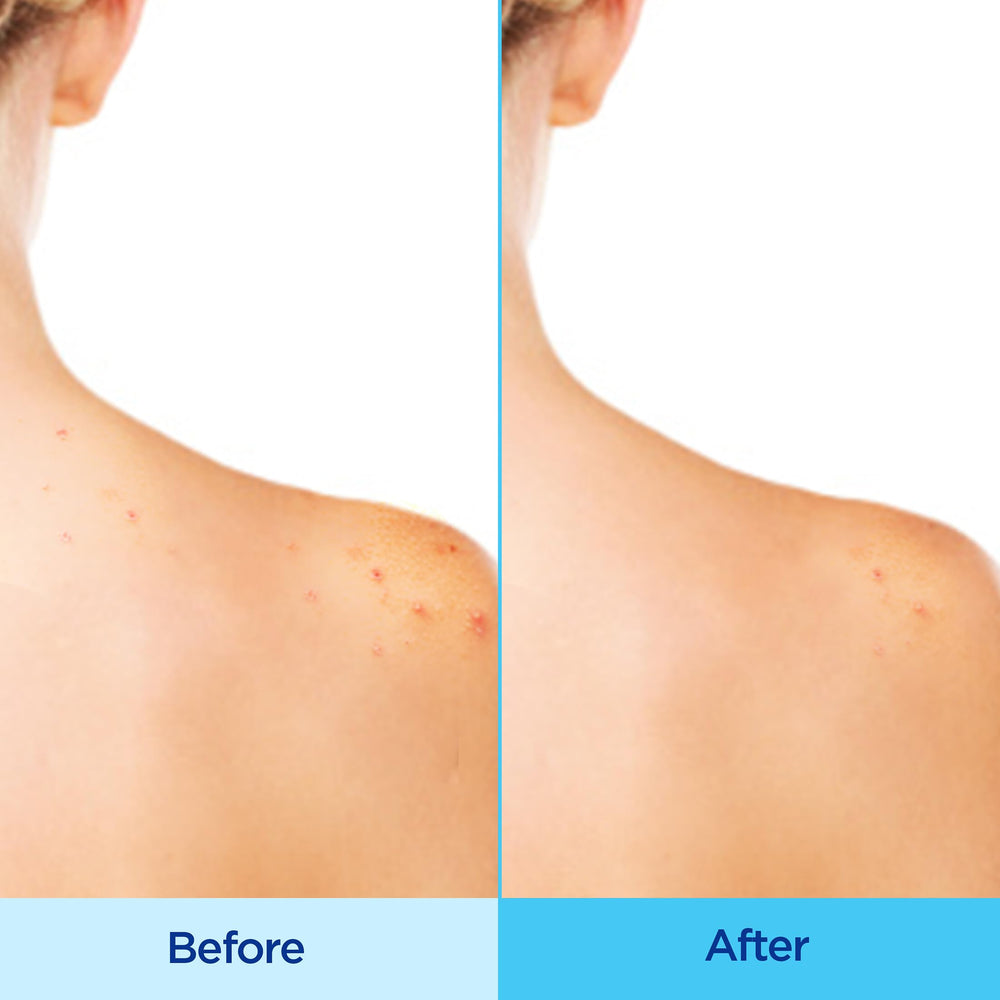 Hands applying Differin to back with even coverage