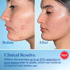 Oil-free formula supports non-comedogenic use with Differin gel