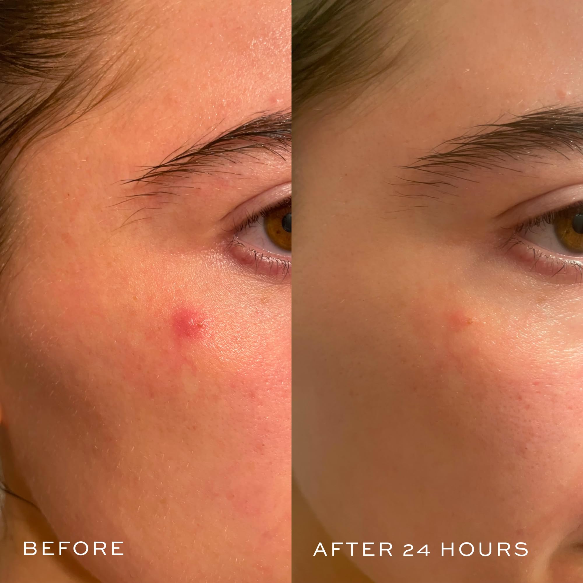 DIME Power Patch stays on overnight for discreet blemish coverage.