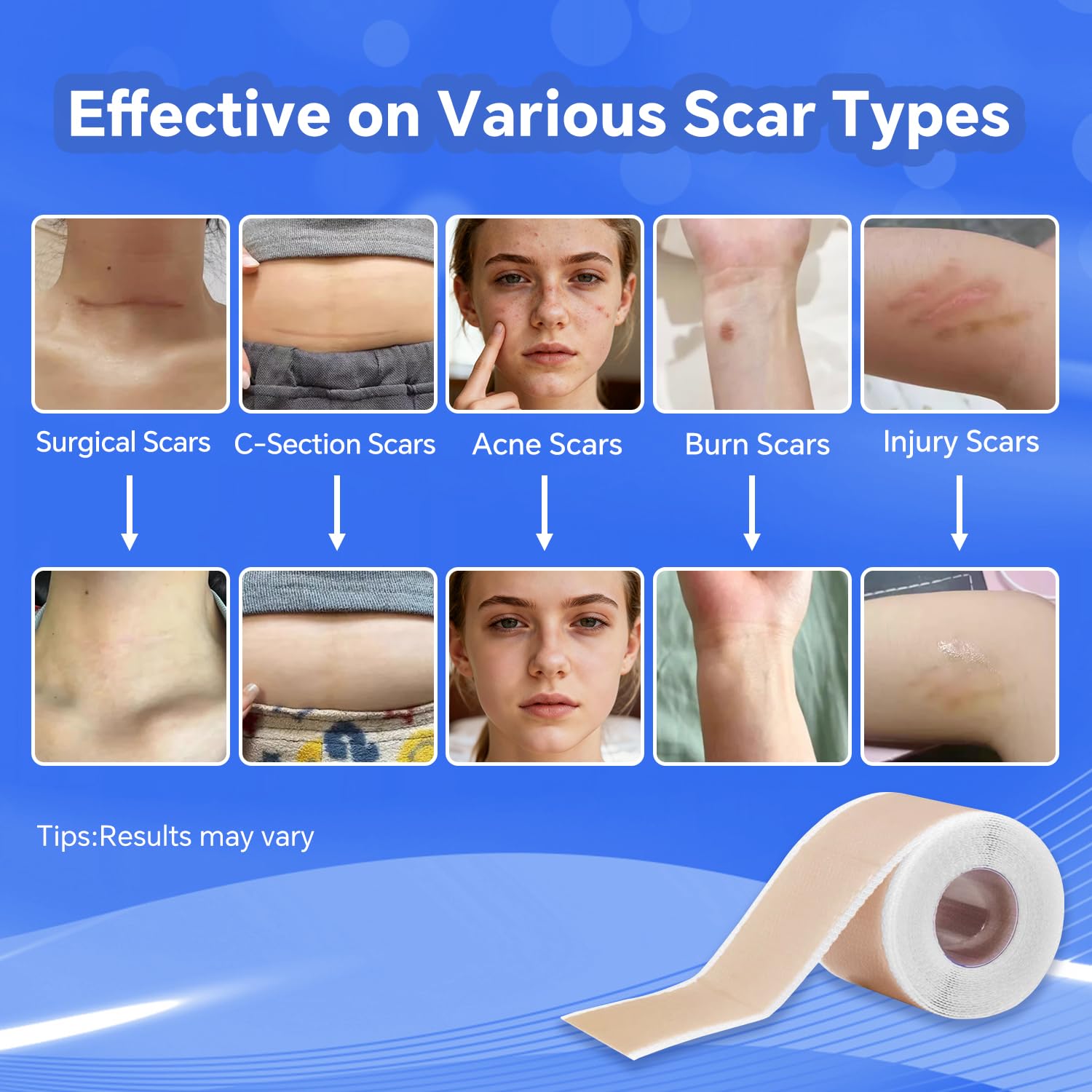 Discoliner silicone scar sheets cut-to-fit demonstrate precise shaping for any scar.