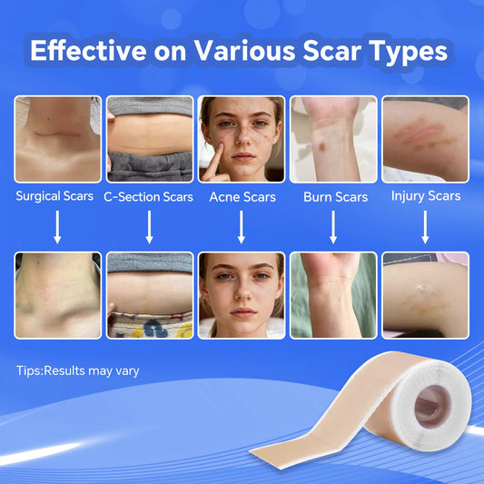 Discoliner silicone scar sheets cut-to-fit demonstrate precise shaping for any scar.
