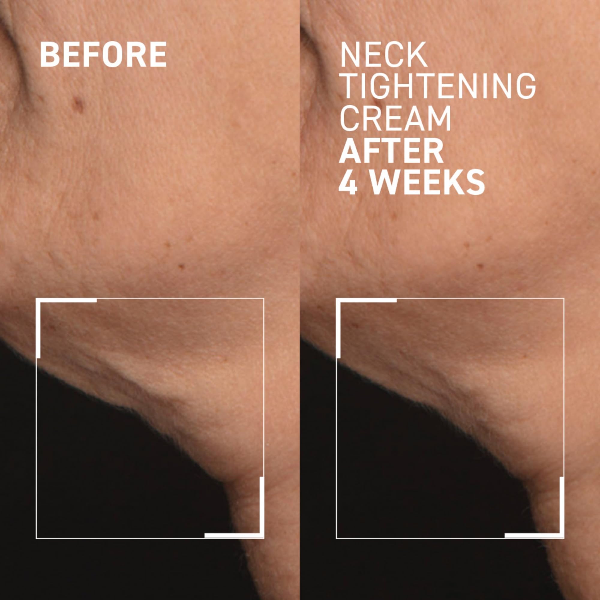 Dr Brandt neck area before and after view highlighting sag reduction.