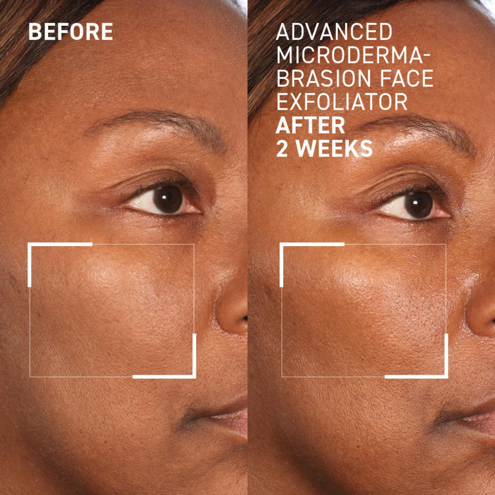 Close-up of aluminum crystals for deep, gentle resurfacing by Dr. Brandt.
