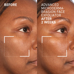 Close-up of aluminum crystals for deep, gentle resurfacing by Dr. Brandt.