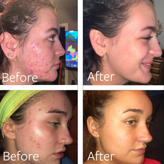Dr Song benzoyl peroxide wash foaming action demonstrates thorough cleansing for acne