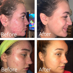 Dr Song benzoyl peroxide wash foaming action demonstrates thorough cleansing for acne