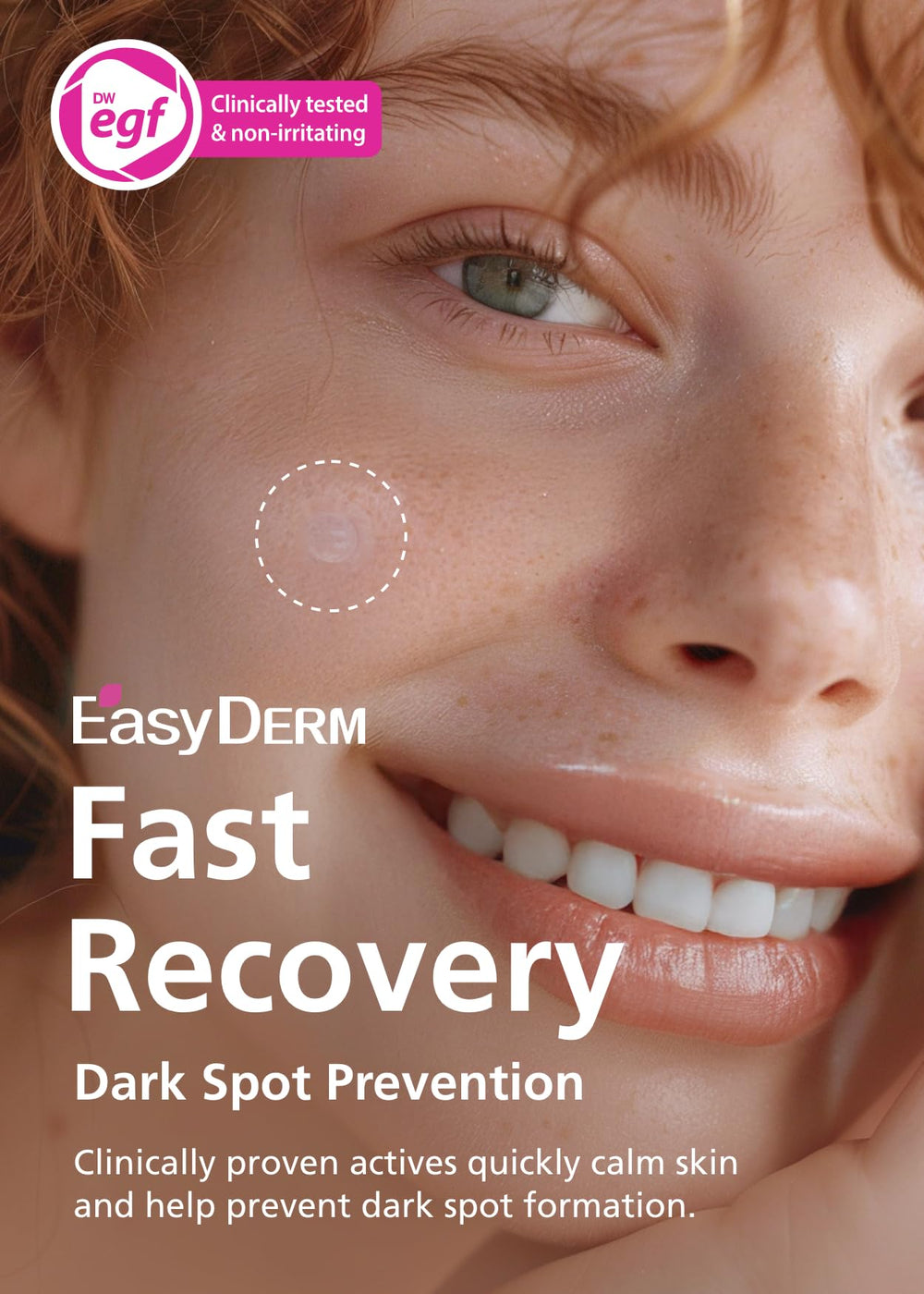 DWEasyDerm pimple patch closeup with micro-point detail on blemish-prone skin.