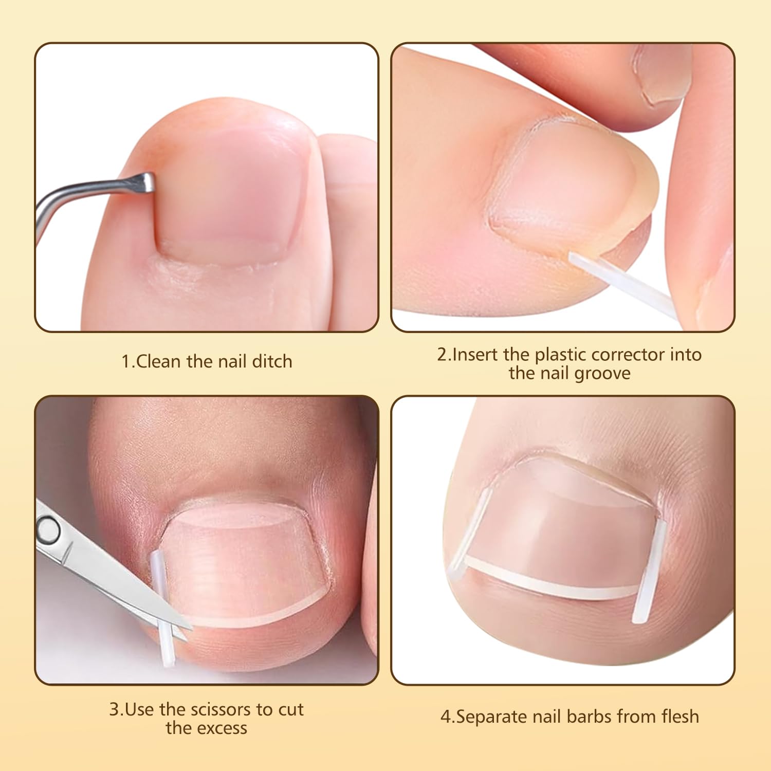 Dynaxor ingrown nail lifter tool for clean edge lifting