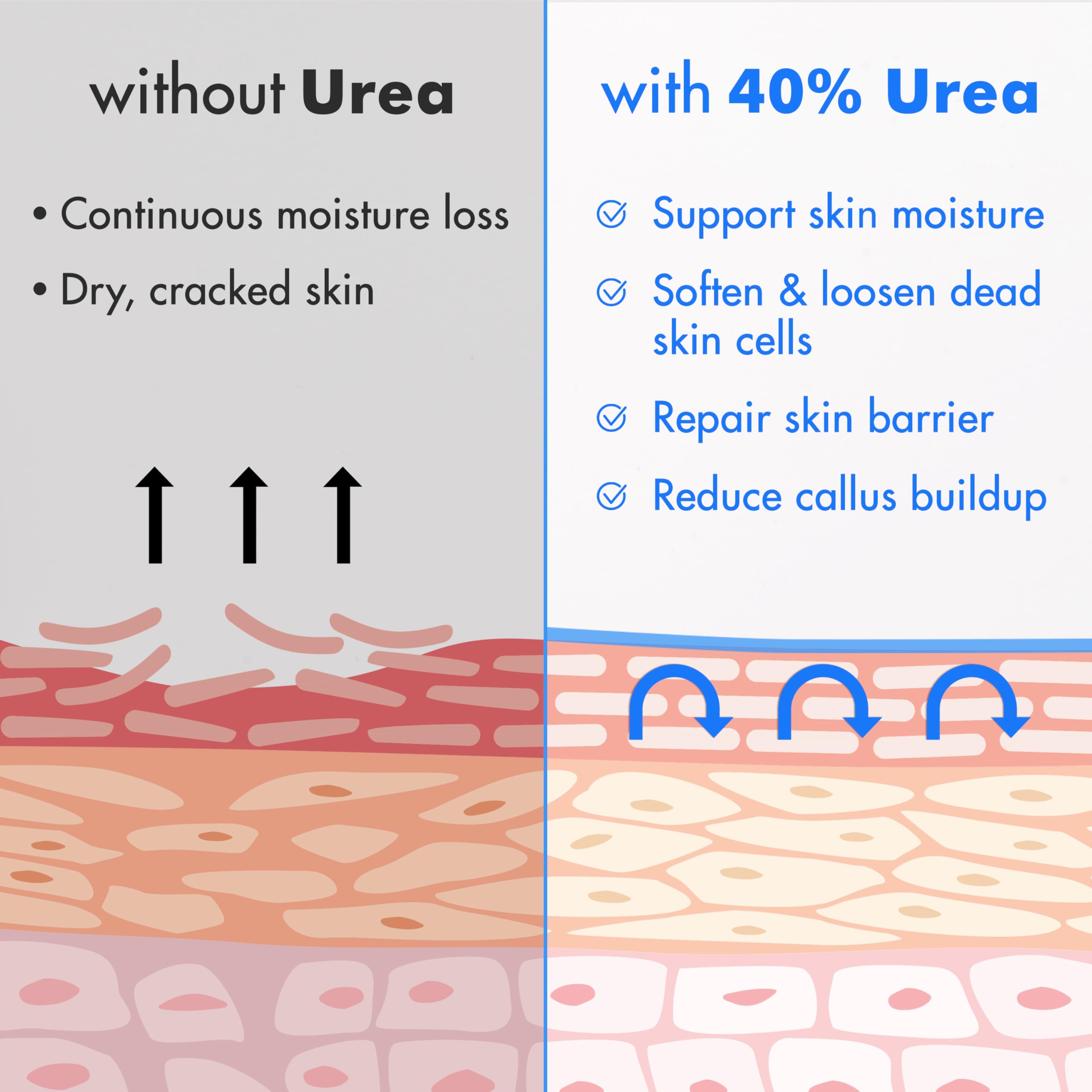 Ebanel Urea Cream 40% on heel care and rough skin