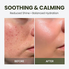 Elravie HyCicaMue Defence Cream application demonstrating soothing touch on irritated skin