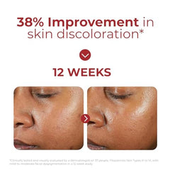 EltaMD UV Clear transparent zinc oxide finish seen on skin for balanced tone.