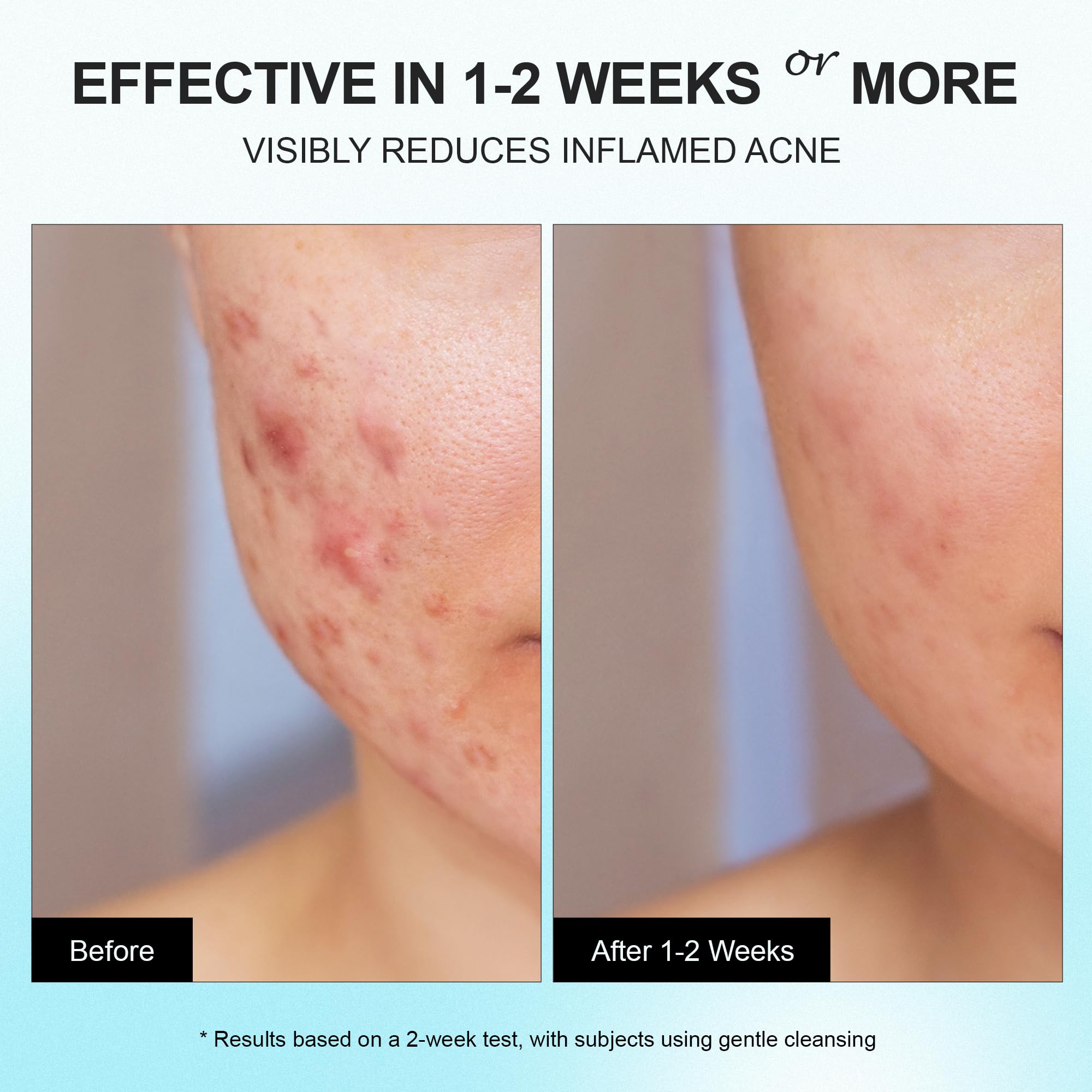 Tea Tree Oil in Enaskin Naturals aids in fading post-acne marks over time.