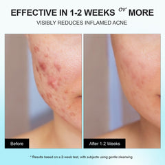 Tea Tree Oil in Enaskin Naturals aids in fading post-acne marks over time.