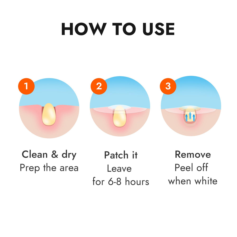 Epielle over-zit patches all-day wear image for daily activities.