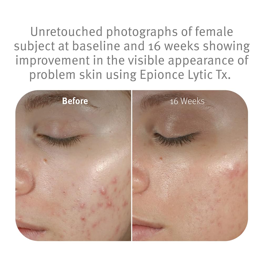 Epionce Lytic Tx texture swatch illustrating gentle exfoliation.