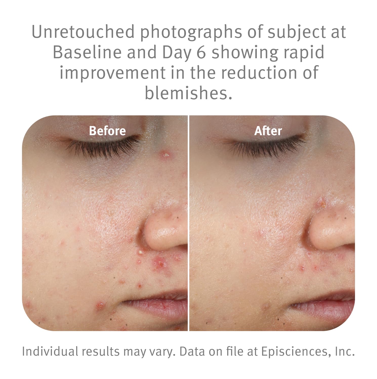 Epionce spot gel aiding pore clearing on skin.