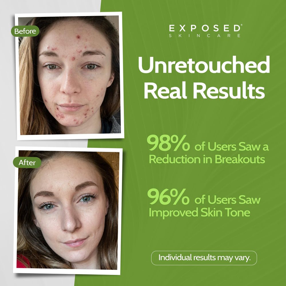 Exposed Skin Care toner close-up focusing on pores and hydration support