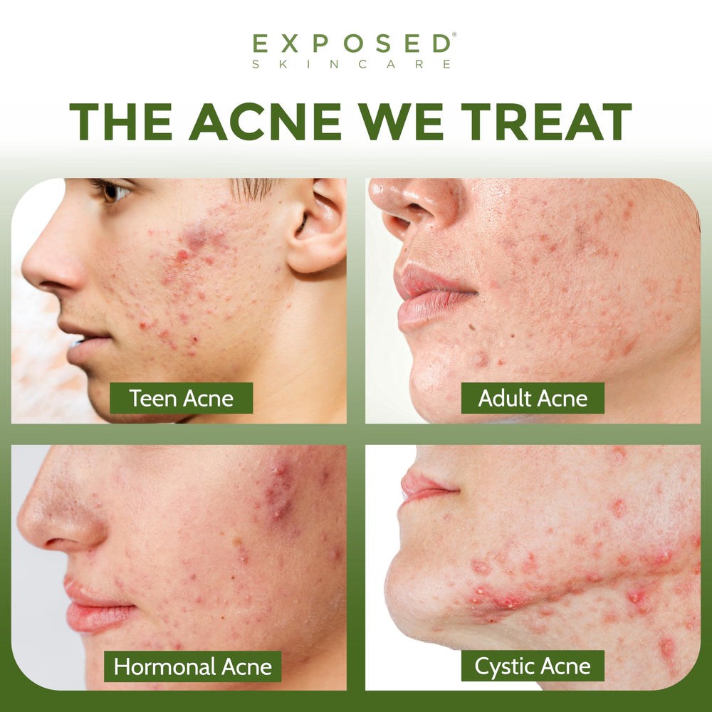 Exposed Skin Care Clearing Tonic pour onto cotton pad for even application.