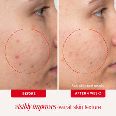 First Aid Beauty Acne Pads with 2% salicylic acid on a clean face.