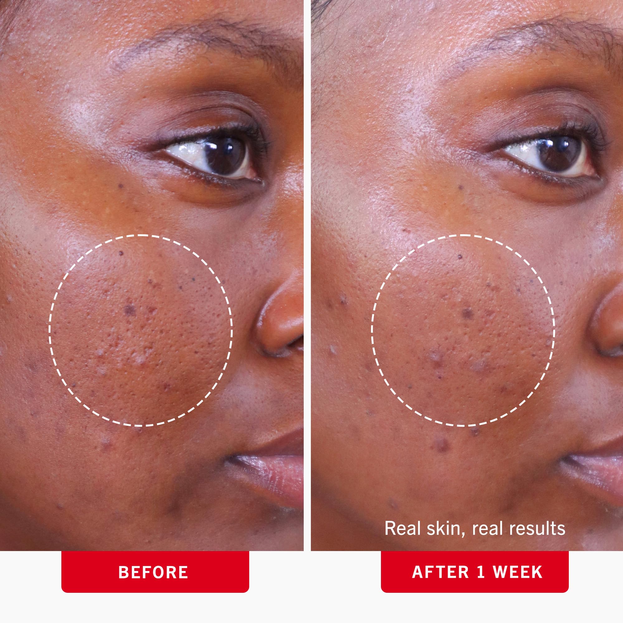First Aid Beauty Acne Pads fragrance-free and alcohol-free formula for sensitive skin.